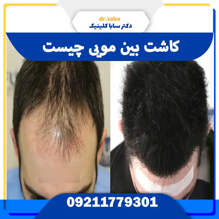 کاشت بین مویی چیست