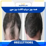 کاشت بین مویی بدون تراشیدن سر و با تراکم طبیعی در کلینیک تخصصی سابا