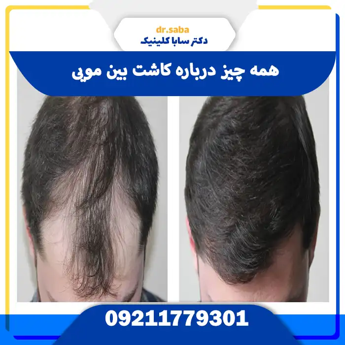 کاشت بین مویی بدون تراشیدن سر و با تراکم طبیعی در کلینیک تخصصی سابا