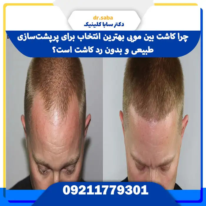 چرا کاشت بین مویی بهترین انتخاب برای پرپشت‌سازی طبیعی و بدون رد کاشت است؟