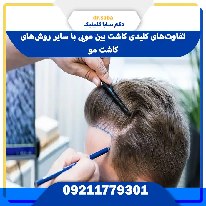 تفاوت‌های کلیدی کاشت بین مویی با سایر روش‌های کاشت مو