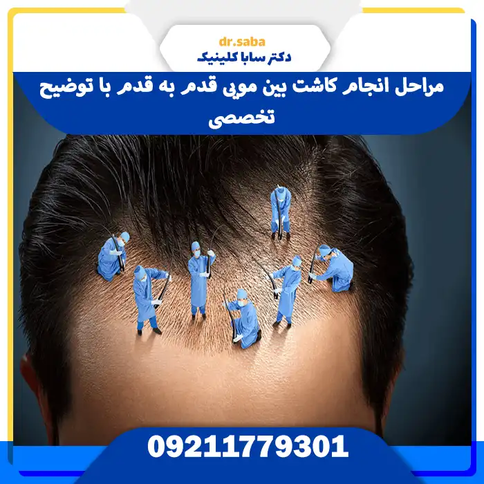 مراحل انجام کاشت بین مویی قدم به قدم با توضیح تخصصی