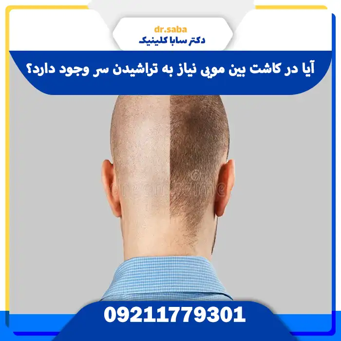 آیا در کاشت بین مویی نیاز به تراشیدن سر وجود دارد؟