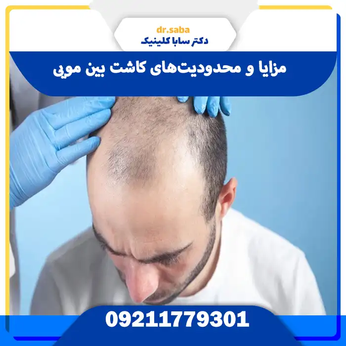 مزایا و محدودیت‌های کاشت بین مویی