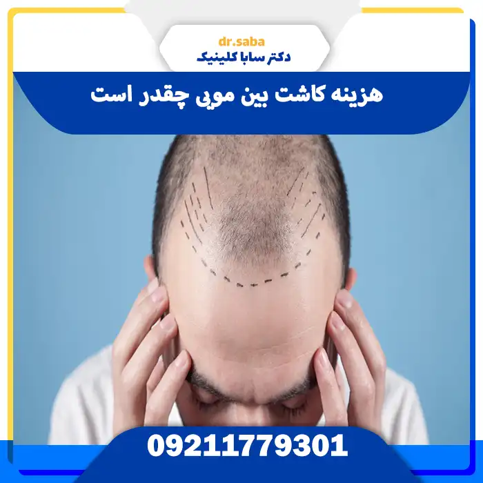 هزینه کاشت بین مویی چقدر است