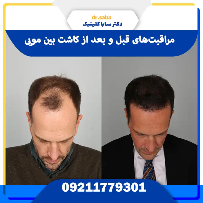 مراقبت‌های قبل و بعد از کاشت بین مویی