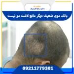 کاشت مو با بانک موی ضعیف در ساباکلنیک – بازیابی تراکم مو با طراحی طبیعی و ارزیابی تخصصی فولیکول‌ها