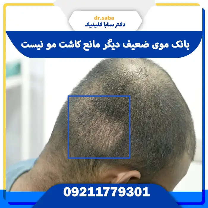 کاشت مو با بانک موی ضعیف در ساباکلنیک – بازیابی تراکم مو با طراحی طبیعی و ارزیابی تخصصی فولیکول‌ها