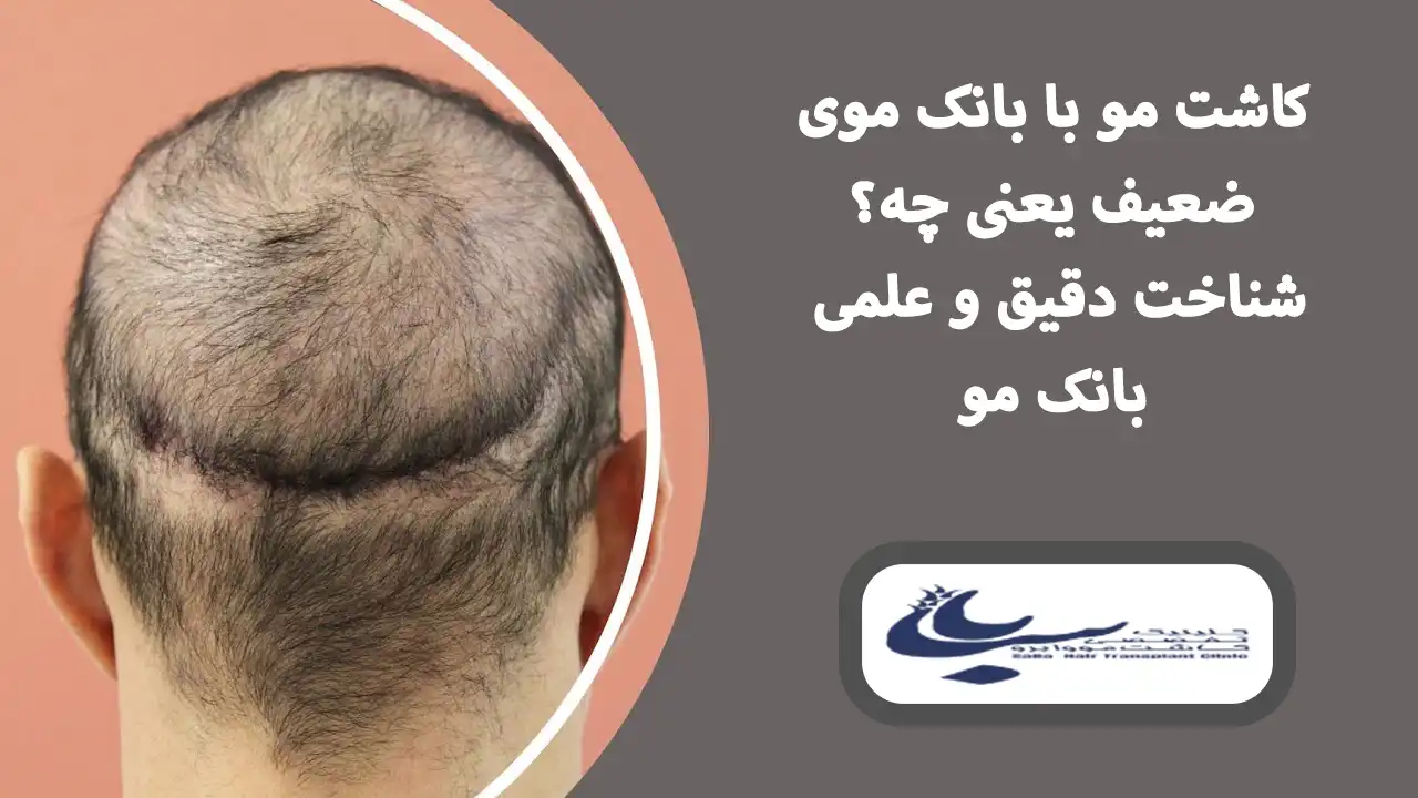 کاشت مو با بانک مو ضعیف با روش های جدید