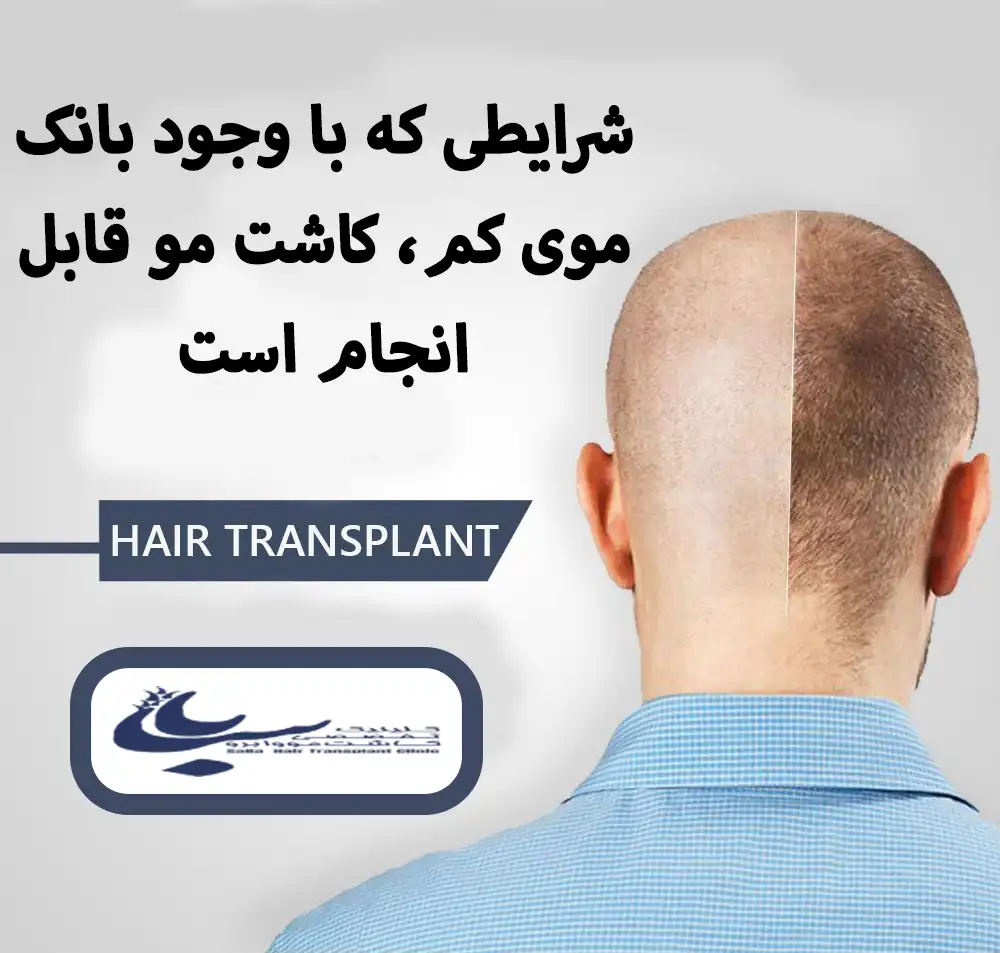 شرایط انجام کاشت مو با بانک موی ضعیف