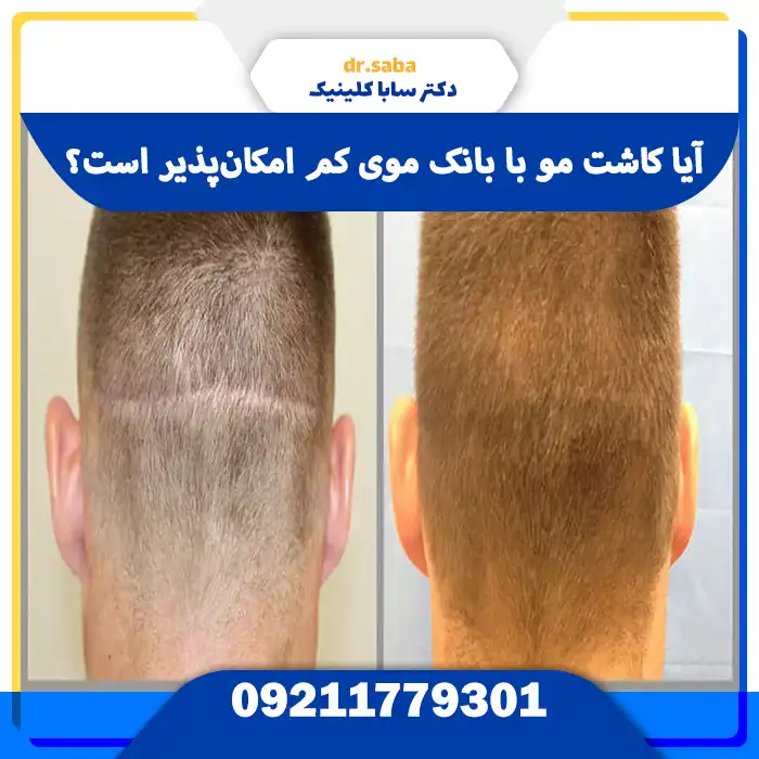 آیا کاشت مو با بانک موی کم امکان‌پذیر است؟
