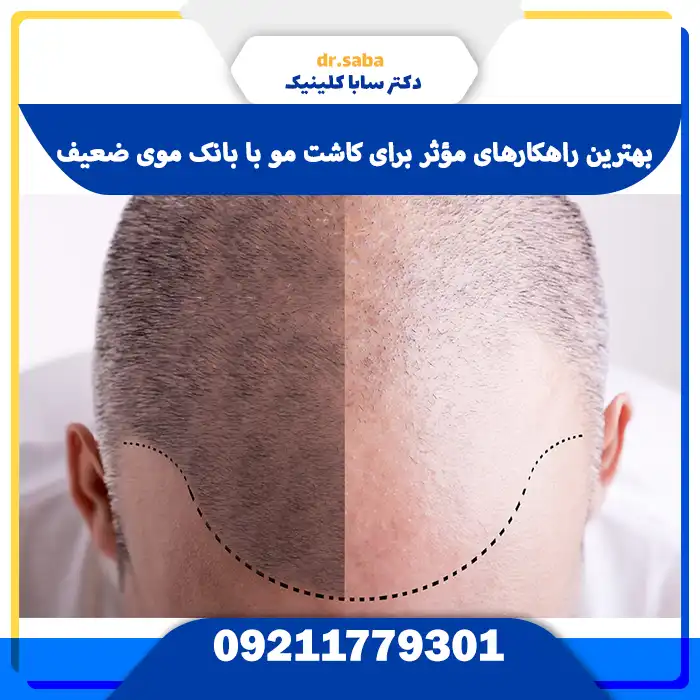 بهترین راهکارهای مؤثر برای کاشت مو با بانک موی ضعیف