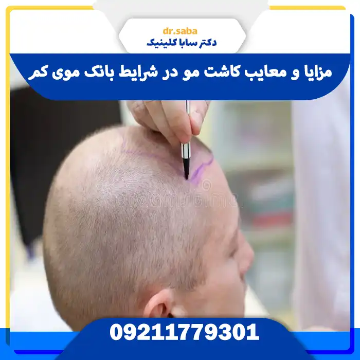 مزایا و معایب کاشت مو در شرایط بانک موی کم