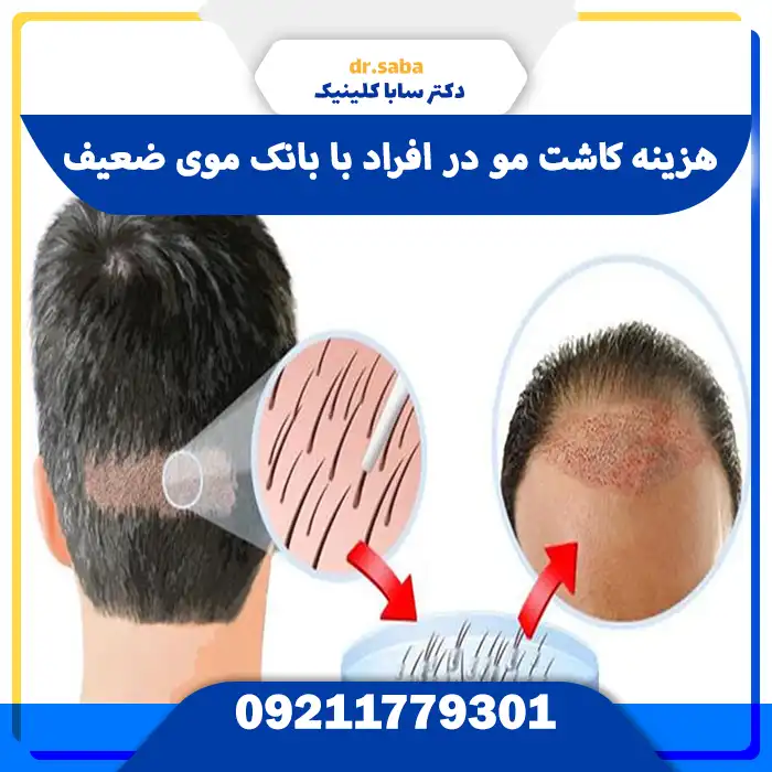 هزینه کاشت مو در افراد با بانک موی ضعیف