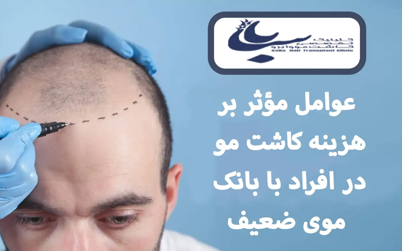 عوامل موثر بر هزینه کاشت مو با بانک مو ضعیف