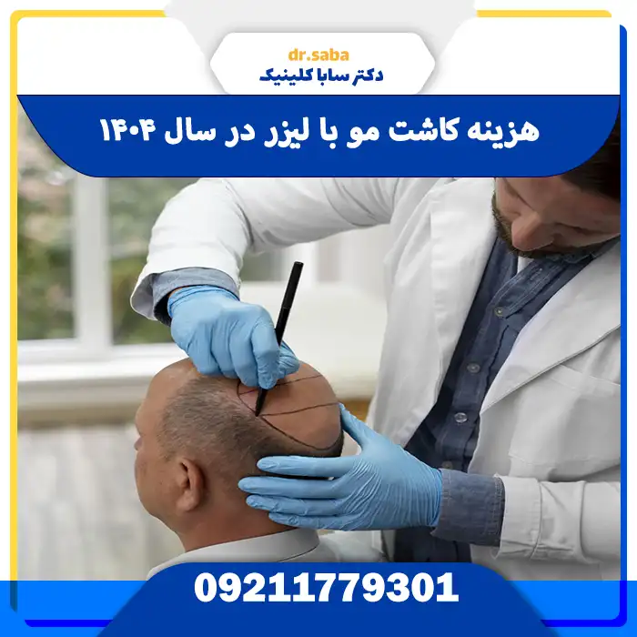 هزینه کاشت مو با لیزر در سال ۱۴۰۴