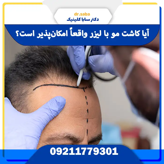 کاشت مو با لیزر در مقایسه با روش‌های FUE و FUT | بررسی تفاوت، هزینه و نتایج نهایی