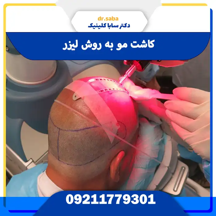 کاشت مو به روش لیزر