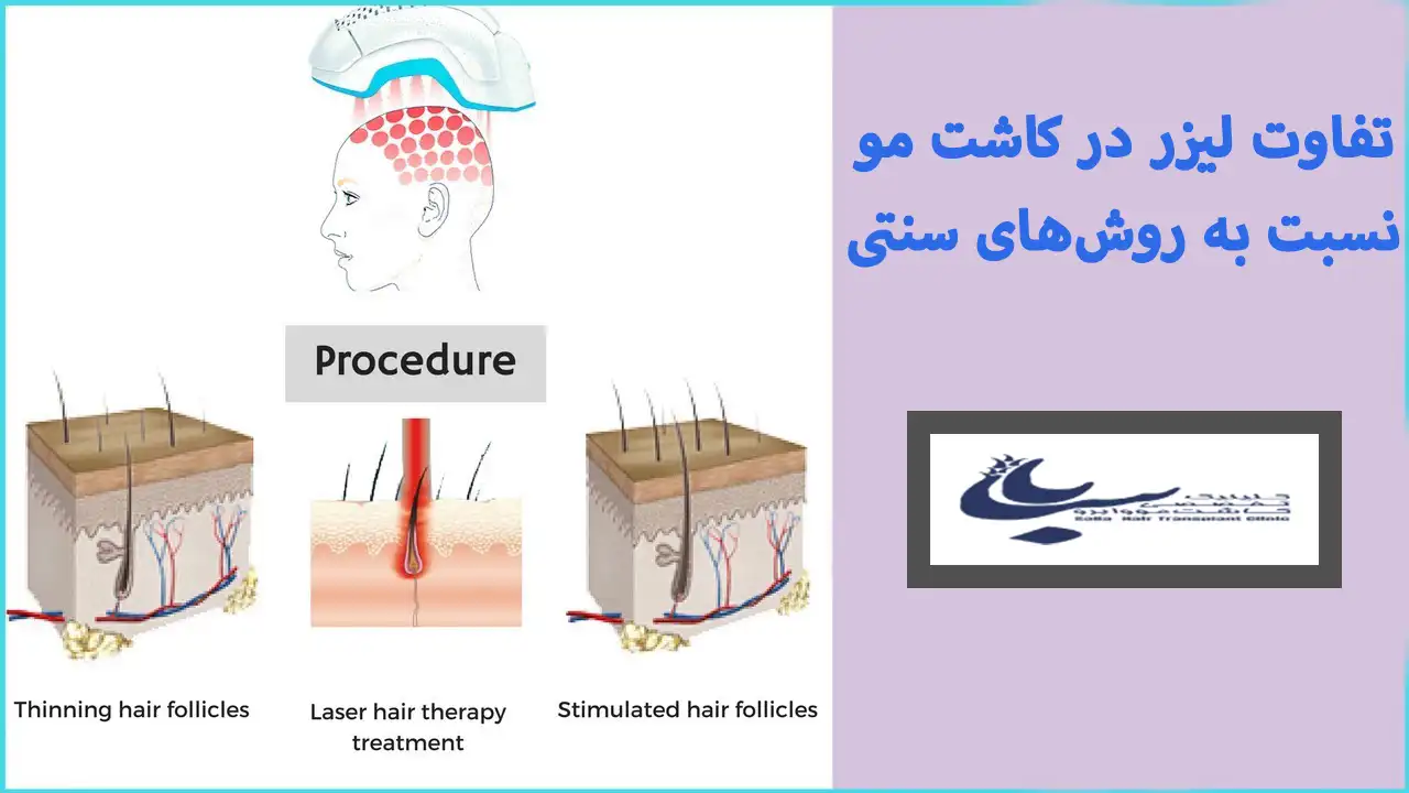 روش های مختاف کاشت مو و لیزر برای کاشت مو