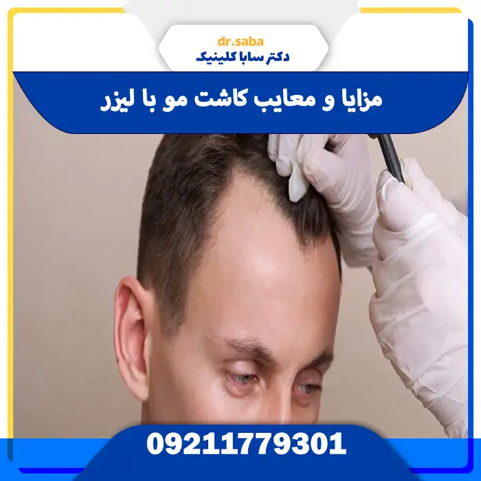 مزایا و معایب کاشت مو با لیزر