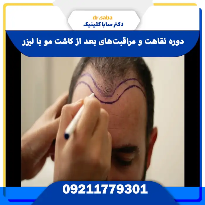 دوره نقاهت و مراقبت‌های بعد از کاشت مو با لیزر